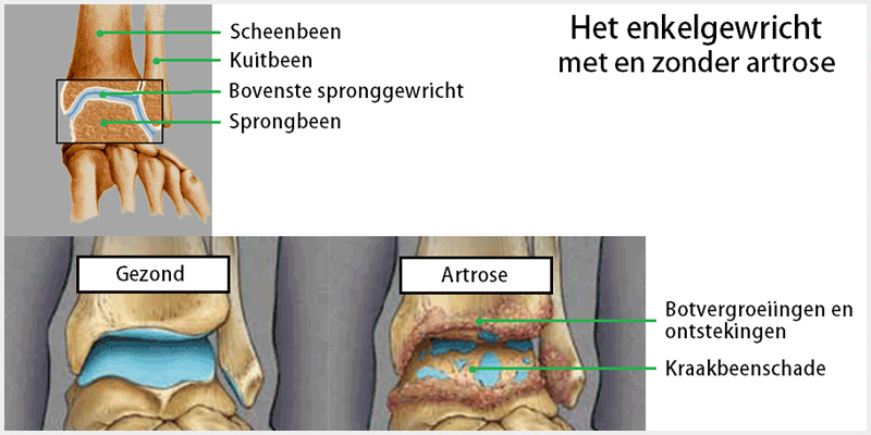 Voet- en enkelartrose (2)