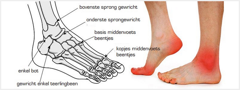 Artrose (1)