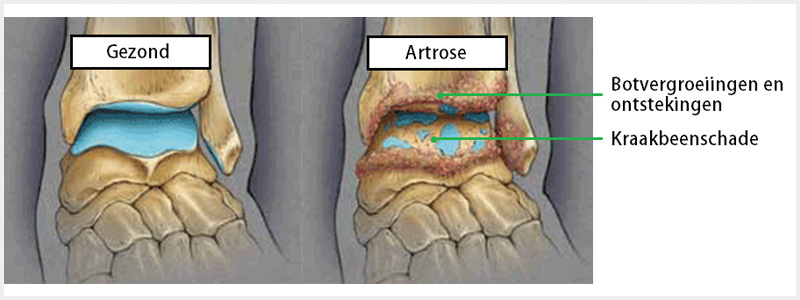 Voet- en enkelartrose (2)