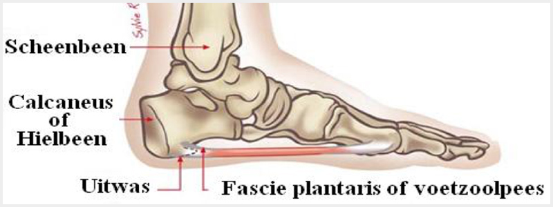 Voetprobleem hielspoor (thema 1)