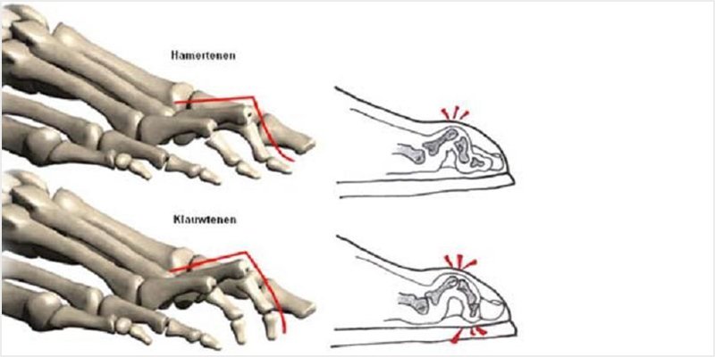 Voetprobleem hamerteen en klauwteen (thema 2.)